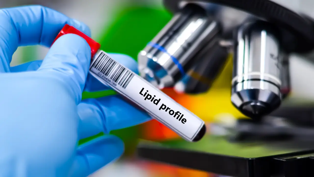 Lipid Profile Test Singapore